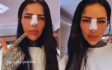 Cande Tinelli contó por qué se hizo una tremenda cirugía estética de nariz