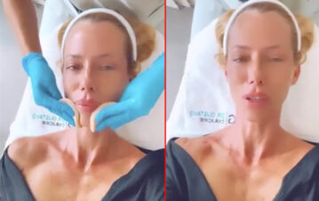 Nicole Neumann se sometió a un tratamiento estético en la cara y mostró los resultados