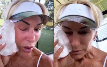 Yanina Latorre sufrió un doloroso accidente en el rostro y sus fotos generaron preocupación